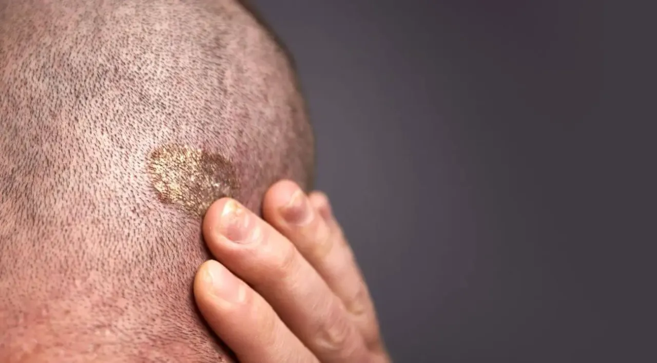 Zdjęcie Czy pryszcz sam zniknie? Poznaj prawdę o naturalnym gojeniu