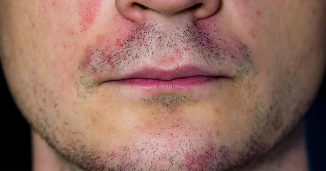 Zdjęcie Trockene Gesichtshaut mit Schuppen: Ursachen und effektive Lösungen