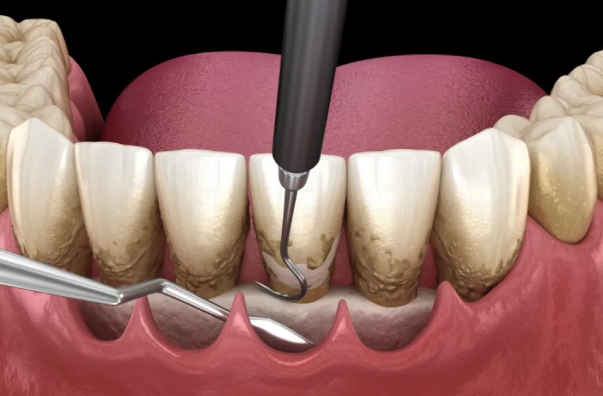 Zdjęcie Czy zęby trzonowe wypadają? Przyczyny, zapobieganie i skuteczne metody leczenia