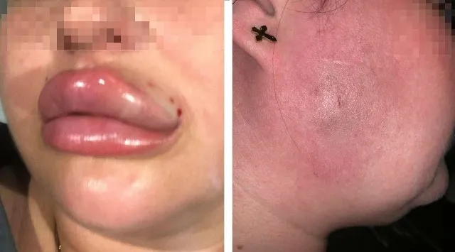 Zdjęcie Jak uśmierzyć ból po powiększaniu ust - skuteczne metody i porady