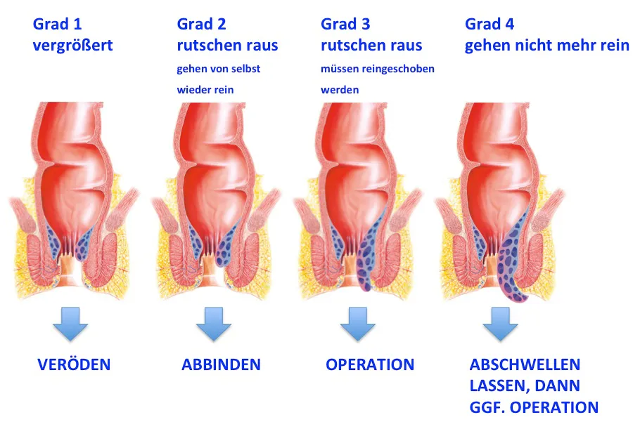 Zdjęcie Hämorrhoiden Symptome: Erkennen Sie die Anzeichen und vermeiden Sie Schmerzen