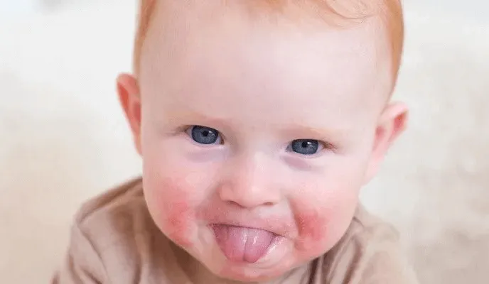 Zdjęcie Alergia na truskawki u niemowlaka: objawy, czas reakcji i jak postępować