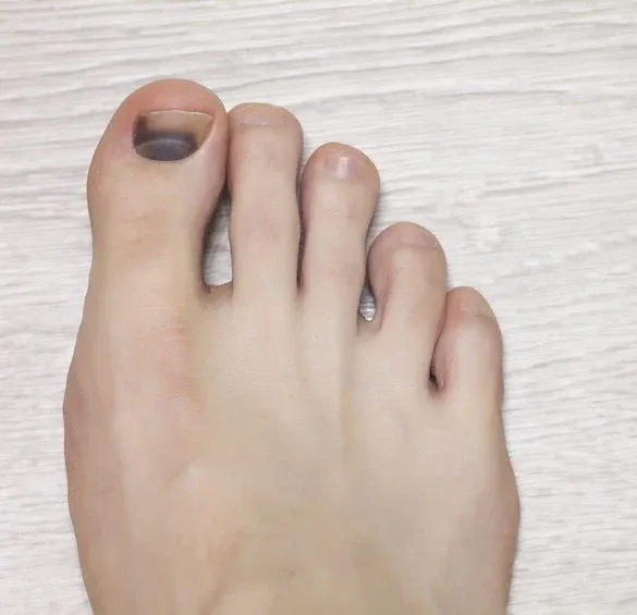 Zdjęcie Jak skutecznie zmniejszyć ból krwiaka pod paznokciem i odzyskać komfort