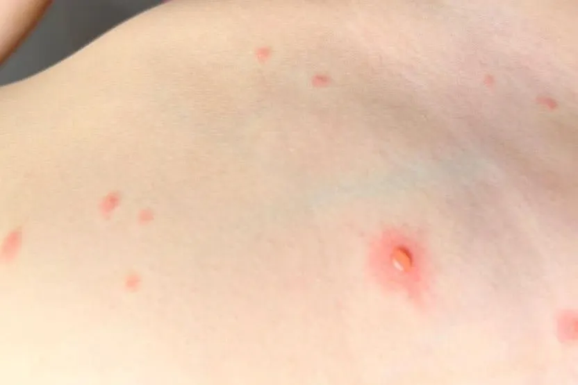 Zdjęcie Jaki lek na gorączkę przy ospie? Paracetamol czy ibuprofen?