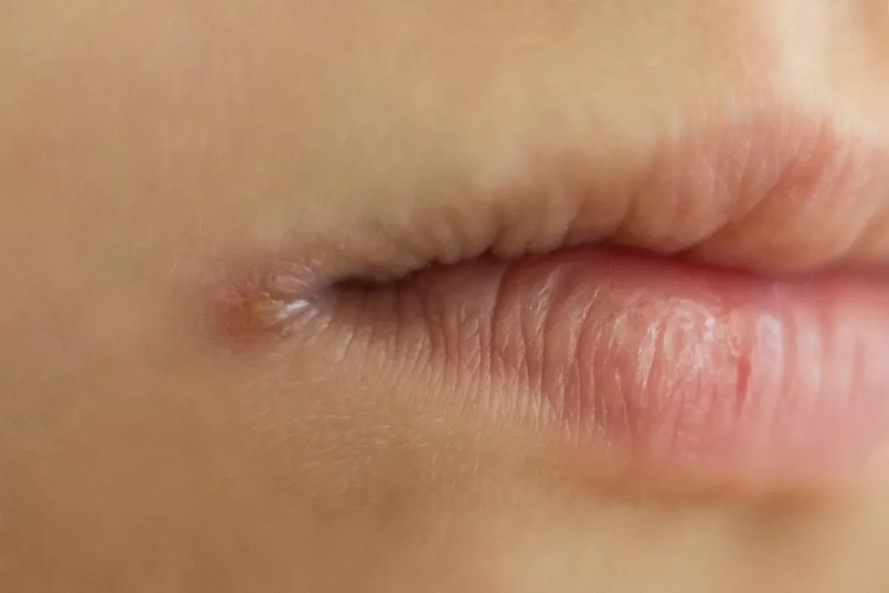 Zdjęcie Czy z zajadami można iść do dentysty? Co warto wiedzieć przed wizytą