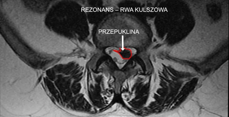 Zdjęcie Skutki uboczne rezonansu magnetycznego kręgosłupa - czy warto się bać?