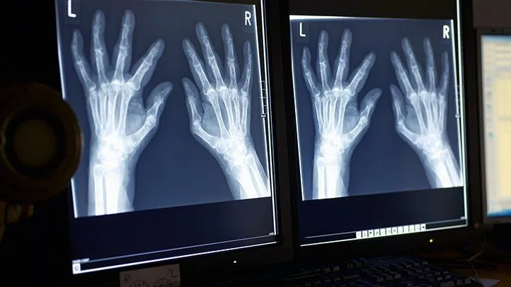 Zdjęcie Jakie badanie na RZS pomoże postawić właściwą diagnozę i ocenić stan zdrowia