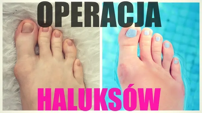 Zdjęcie Ile trwa rekonwalescencja po operacji haluksa i jak ją przyspieszyć