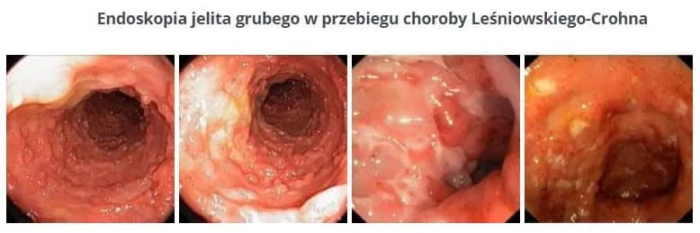 Zdjęcie Choroba Leśniowskiego-Crohna: Jakie badania są kluczowe dla diagnostyki?