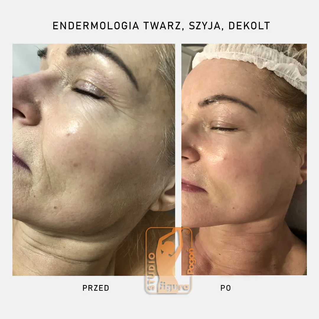 Zdjęcie Endermologia twarzy ile zabiegów potrzebujesz, aby uzyskać efekty?
