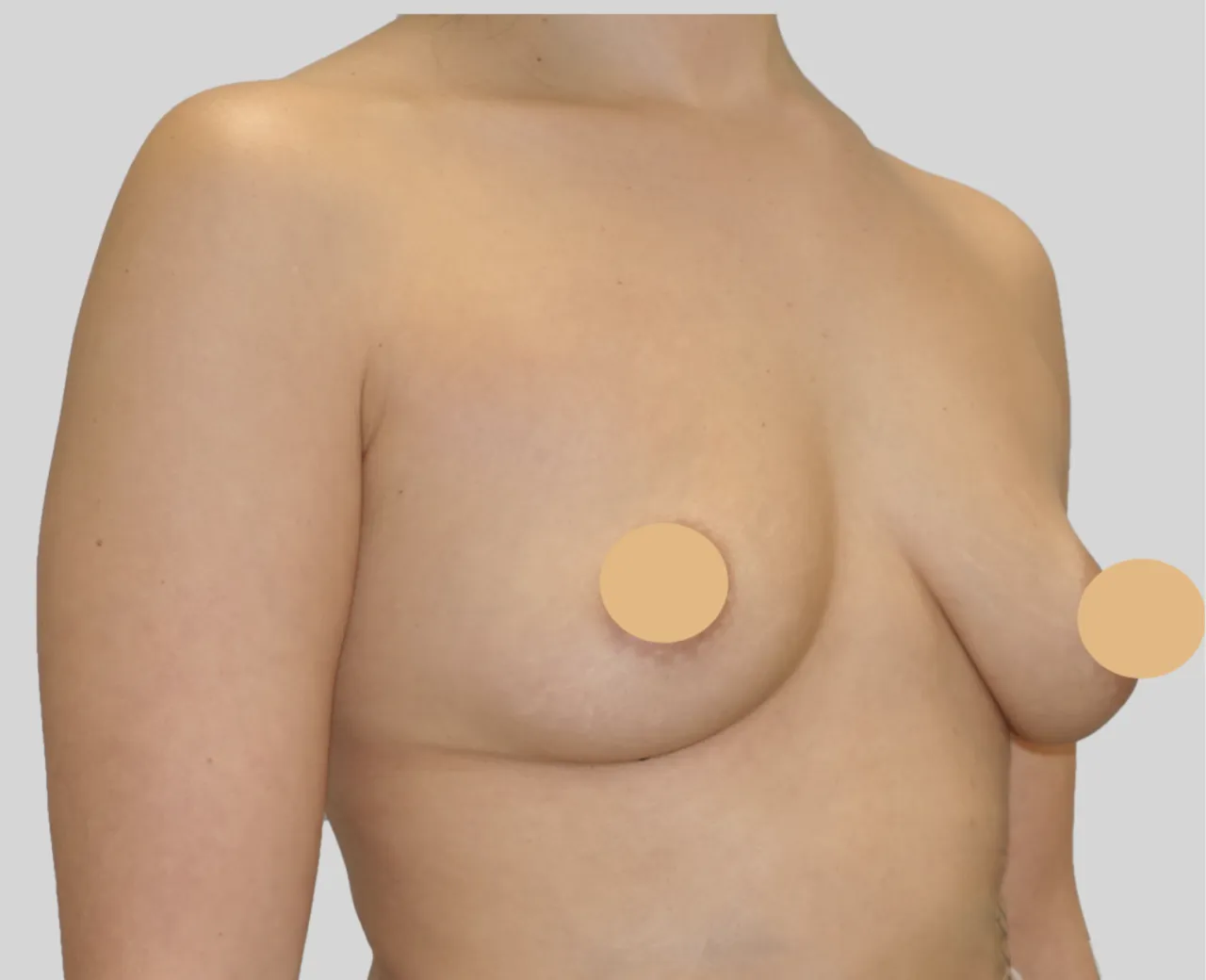 Zdjęcie Ile kosztuje ujędrnienie biustu? Ceny zabiegów i co warto wiedzieć