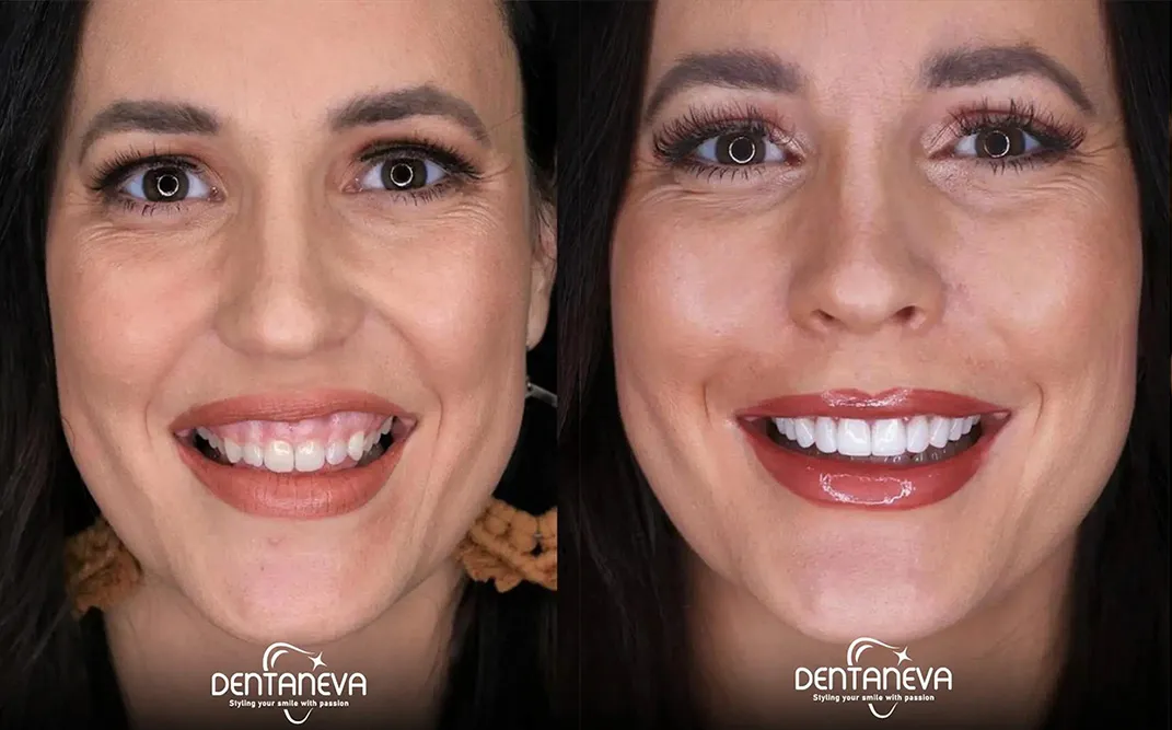 Zdjęcie Ile kosztuje Hollywood Smile: kompletny cennik zabiegów w 2025 roku