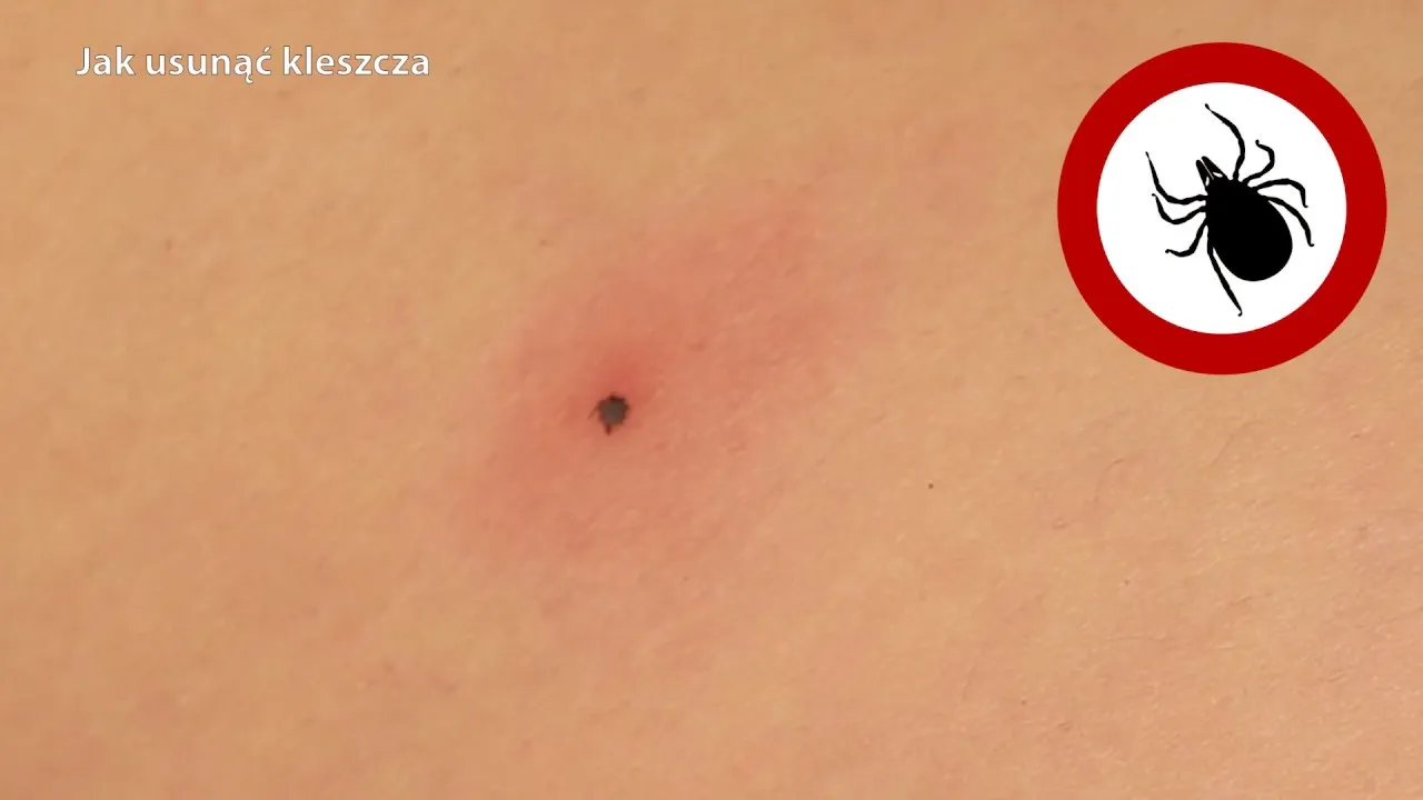 Zdjęcie Jak długo swędzi ugryzienie po kleszczu? Objawy, które powinny niepokoić