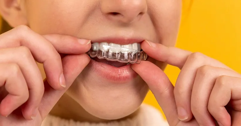 Zdjęcie Ile trzeba nosić aparat na zęby? Czas leczenia i co warto wiedzieć
