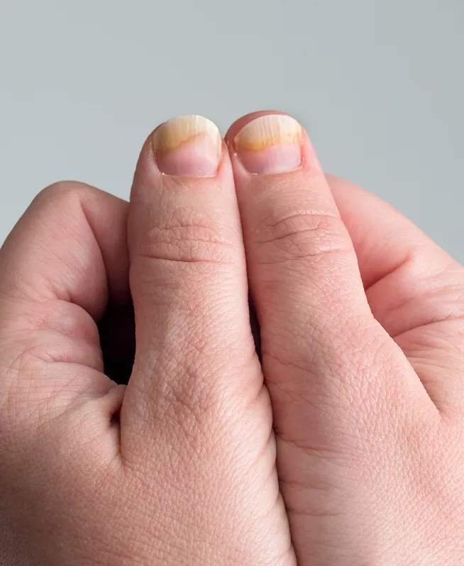 Zdjęcie Jak skutecznie leczyć grzybicę paznokci u rąk po hybrydzie?