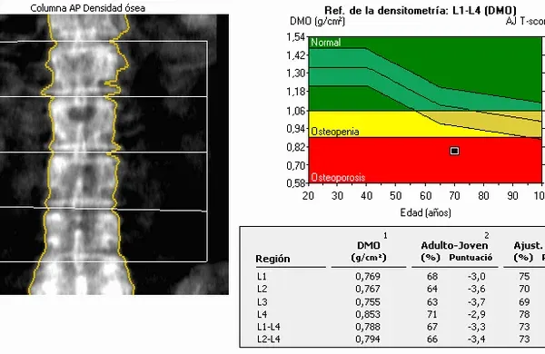 Zdjęcie Die entscheidenden Schritte zur Osteoporose Diagnostik verstehen