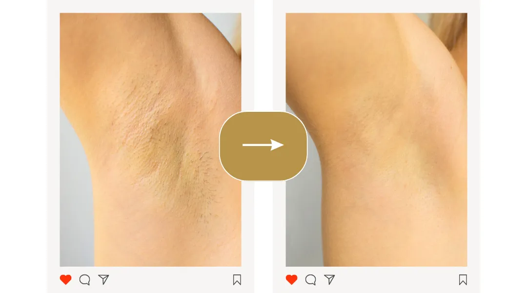 Zdjęcie Koniec z podrażnieniami po depilacji! Moje SOS dla gładkiej sk&oacute;ry