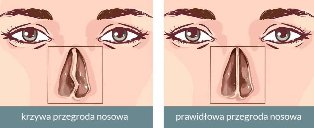 Zdjęcie Krzywa przegroda nosowa objawy - jak rozpoznać problemy zdrowotne?