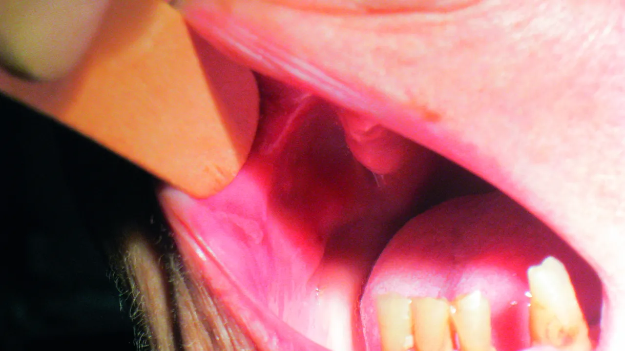 Zdjęcie Skuteczne metody leczenia krwiaka w jamie ustnej po urazie