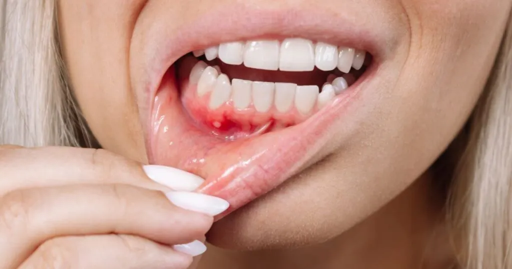 Zdjęcie Czym smarować dziąsło po wyrwaniu zęba, aby uniknąć bólu?