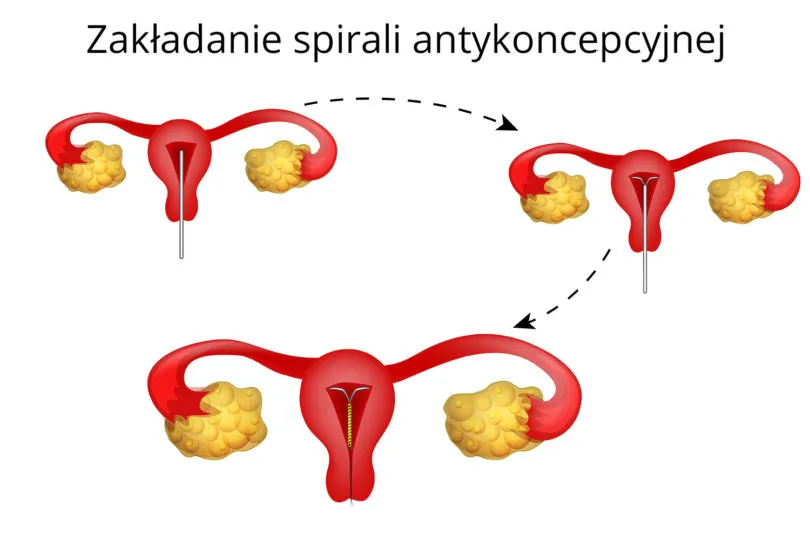 Zdjęcie Spirala po porodzie: kiedy bezpiecznie założyć? Ważne fakty