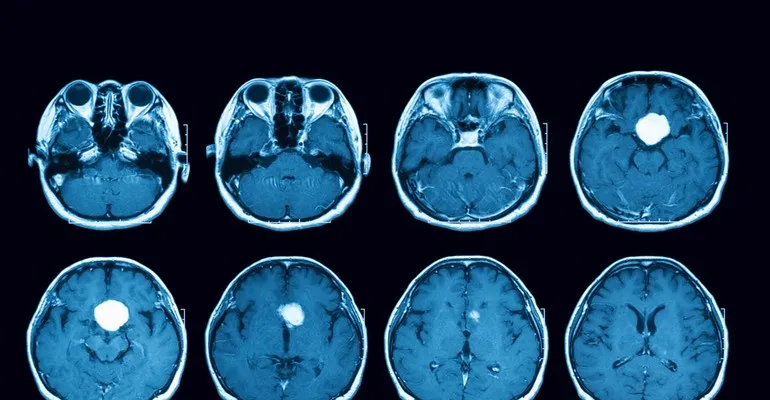 Zdjęcie Gruczolak przysadki: objawy psychiczne, które mogą zaskoczyć