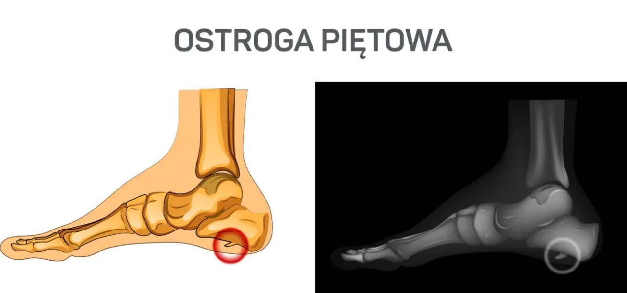 Zdjęcie Jakie leki na ostrogę piętową mogą przynieść ulgę w bólu?