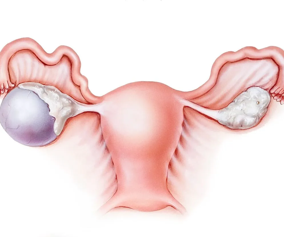 Zdjęcie Czy torbiel czekoladowa może się wchłonąć? Prawda o leczeniu i objawach