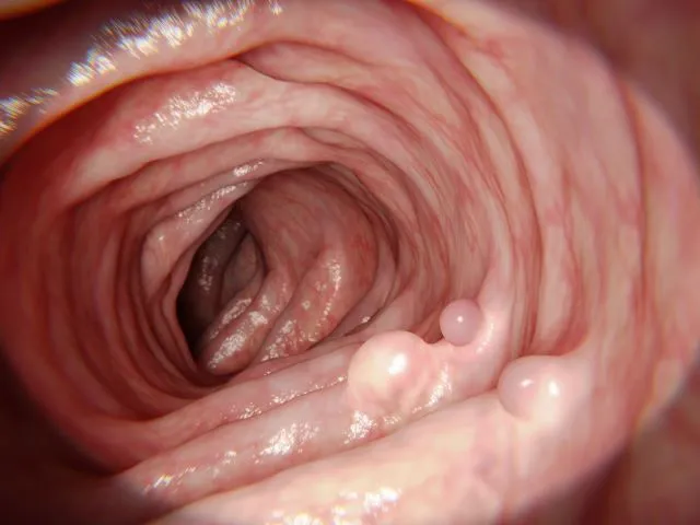 Zdjęcie Ból esicy objawy: Jak rozpoznać niebezpieczne symptomy?