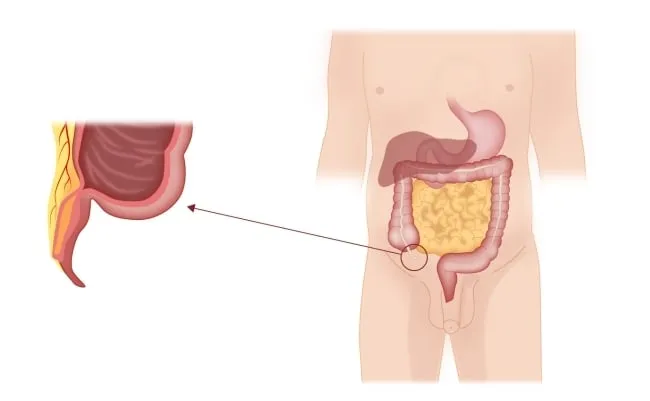 Zdjęcie Jakie badania na wyrostek — kluczowe informacje o diagnostyce zapalenia.