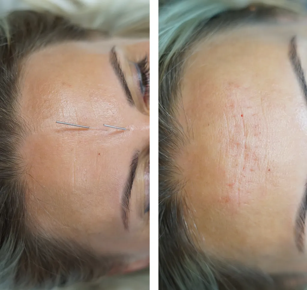 Zdjęcie Punkty akupunktury na twarzy: naturalny lifting i ukojenie