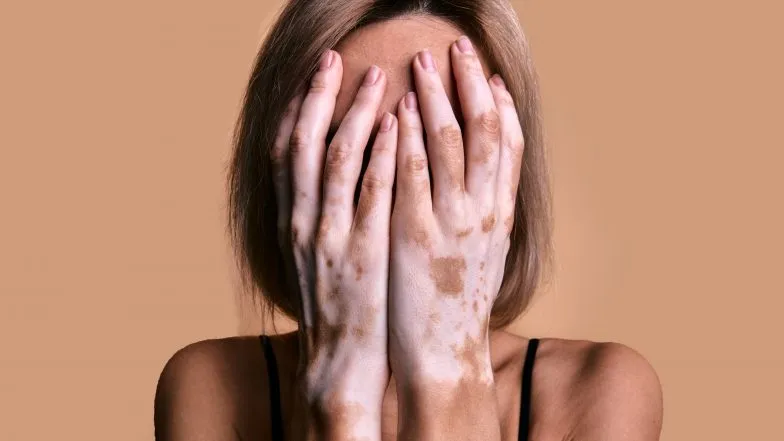 Zdjęcie Bielactwo: Pierwszy lek Opzelura i skuteczne terapie. Czy jest szansa?