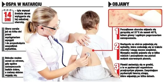 Zdjęcie Ospa wietrzna: kiedy do lekarza, aby uniknąć poważnych komplikacji