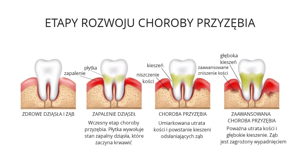 Zdjęcie Jak skutecznie wyleczyć zapalenie dziąseł domowymi sposobami i uniknąć bólu