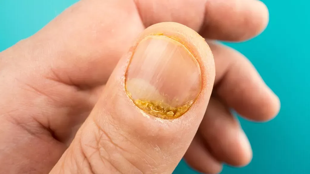 Zdjęcie Uszkodzona macierz paznokcia: jak leczyć? Domowe i profesjonalne metody