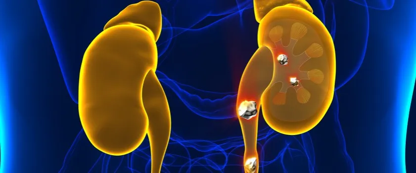 Zdjęcie Czy badanie moczu wykryje kamicę nerkową? Odkryj prawdę o diagnozie