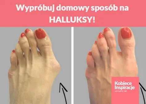 Zdjęcie Jak wyprostować haluksy – skuteczne metody leczenia i zapobiegania bólowi
