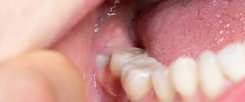 Zdjęcie W jakim wieku rośnie ząb mądrości? Poznaj zaskakujące fakty