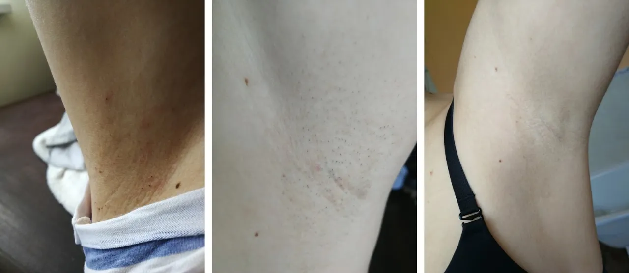 Zdjęcie Ile zabiegów depilacji laserowej pachy potrzebujesz, aby być gładką?