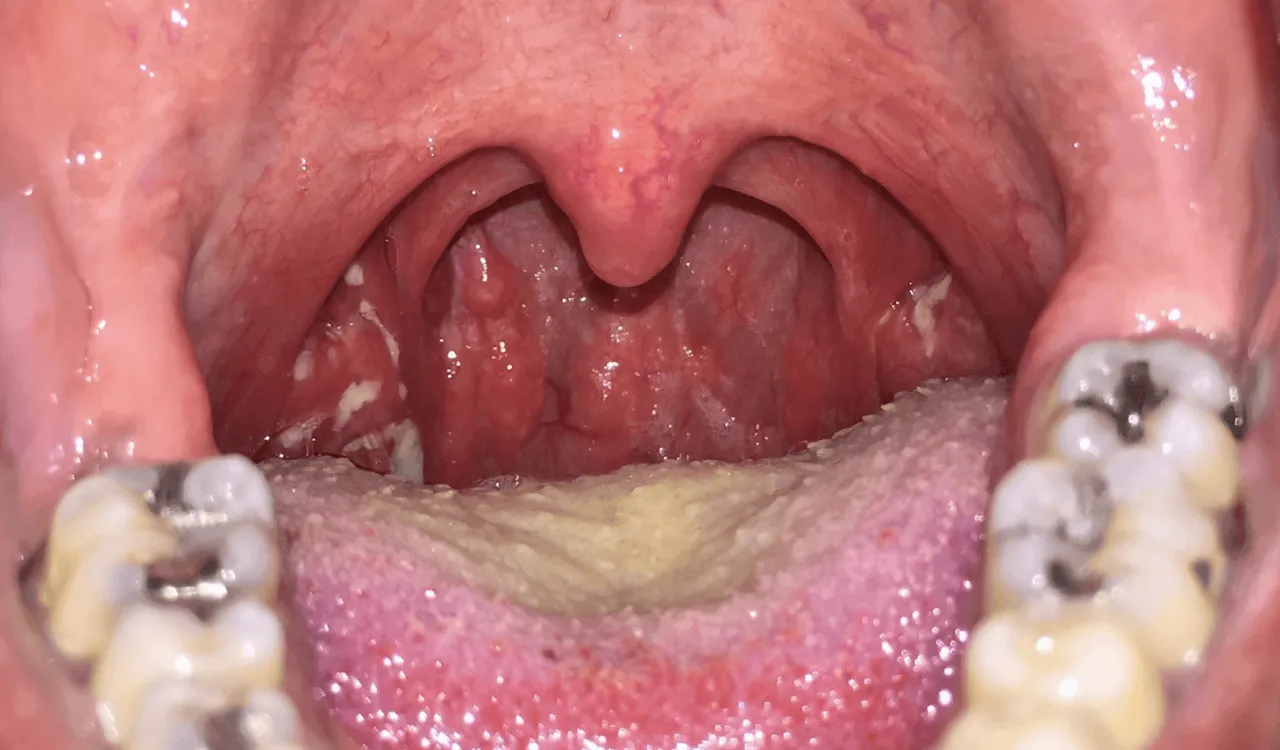 Zdjęcie Angina? Co zjeść na obiad, by gardło przestało boleć?