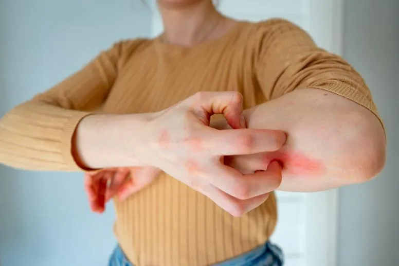 Zdjęcie Alergia na lateks objawy - jak rozpoznać niebezpieczne reakcje?