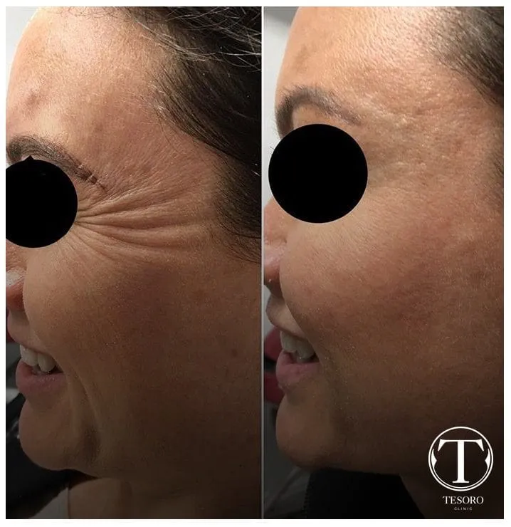 Zdjęcie Ile kosztuje botoks na kurze łapki? Ceny w Polsce i co wpływa na nie