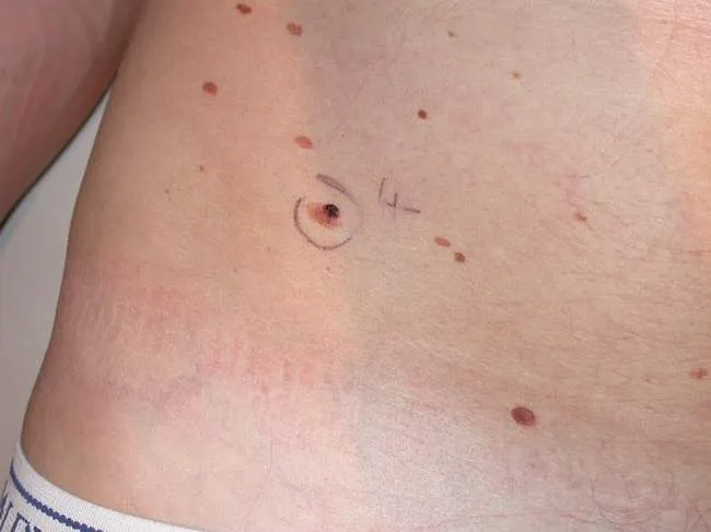 Zdjęcie Co oznacza, gdy pieprzyk boli jak pryszcz? Sprawdź to teraz