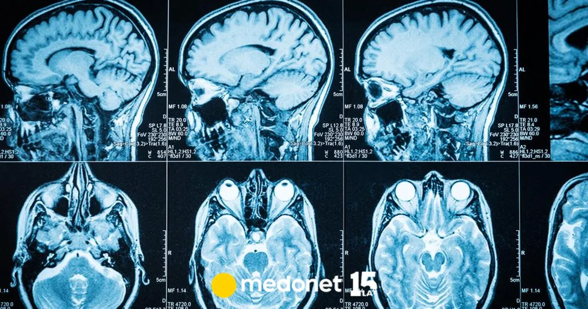 Zdjęcie Guz mózgu objawy psychiczne - jak rozpoznać niepokojące symptomy