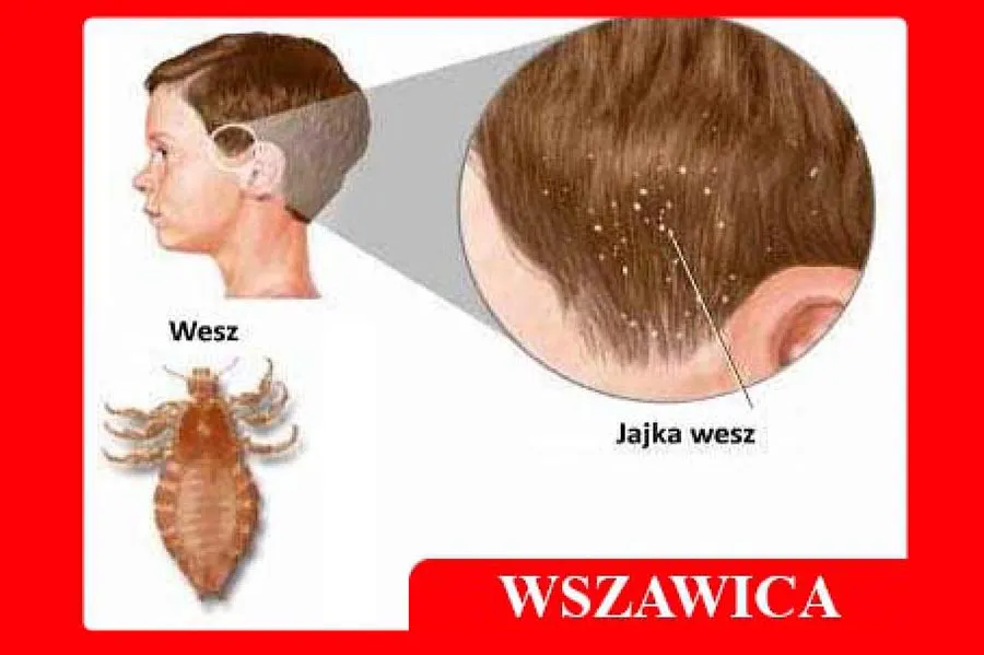Zdjęcie Czy farbowanie włosów zabija wszy? Oto prawda o zwalczaniu wszawicy