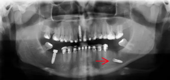 Zdjęcie Ropowica dna jamy ustnej: Objawy, które mogą zagrażać życiu