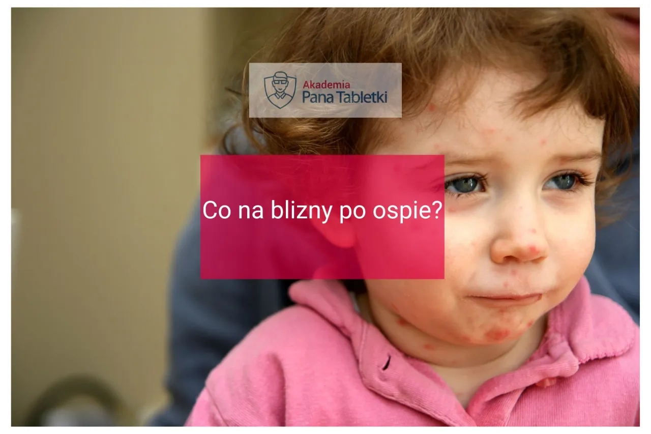 Zdjęcie Czy dziecko ze strupami po ospie może iść do przedszkola? Ważne zasady i zalecenia