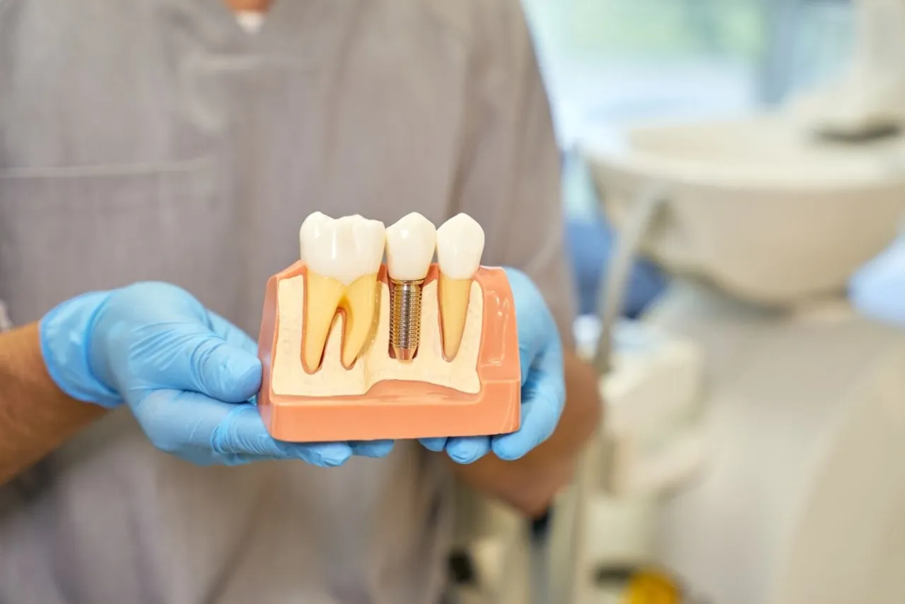 Zdjęcie Kiedy implant po wyrwaniu zęba? Poznaj kluczowe terminy i ryzyka