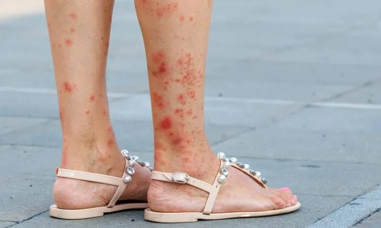 Zdjęcie Pryszcze na nogach od czego? Odkryj przyczyny i skuteczne rozwiązania