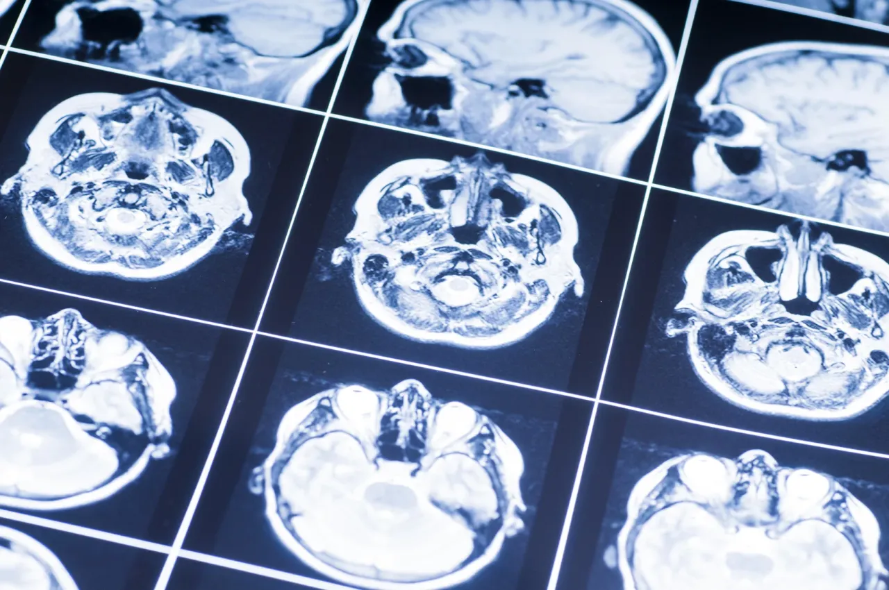 Zdjęcie Guz mózgu czy nerwica - jak nie pomylić objawów i diagnozy